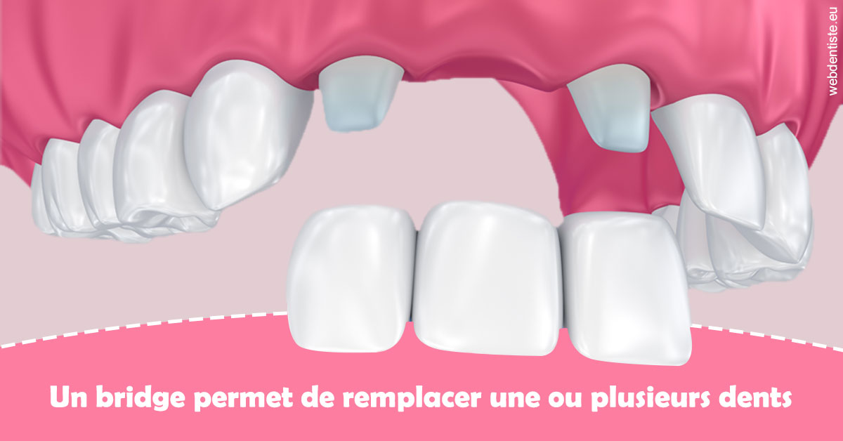 https://selarl-cabdentaire-idrissi.chirurgiens-dentistes.fr/Bridge remplacer dents 2