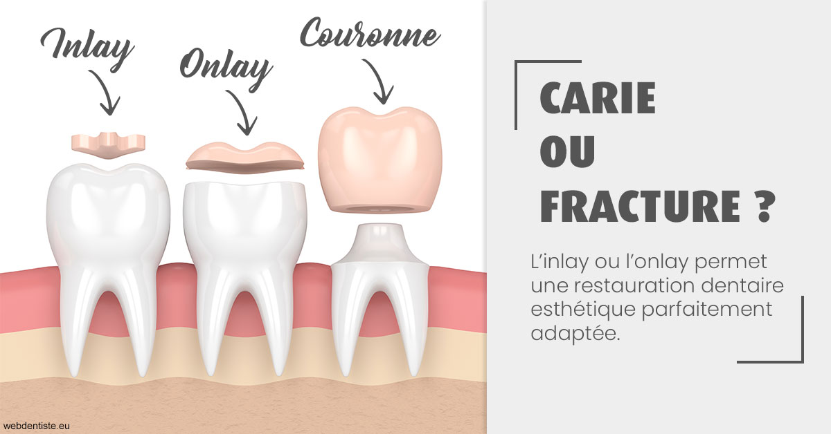 https://selarl-cabdentaire-idrissi.chirurgiens-dentistes.fr/T2 2023 - Carie ou fracture 1