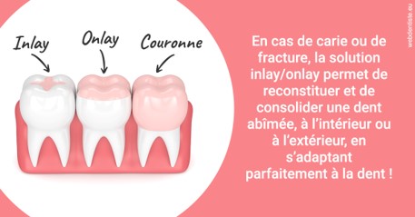 https://selarl-cabdentaire-idrissi.chirurgiens-dentistes.fr/L'INLAY ou l'ONLAY 2