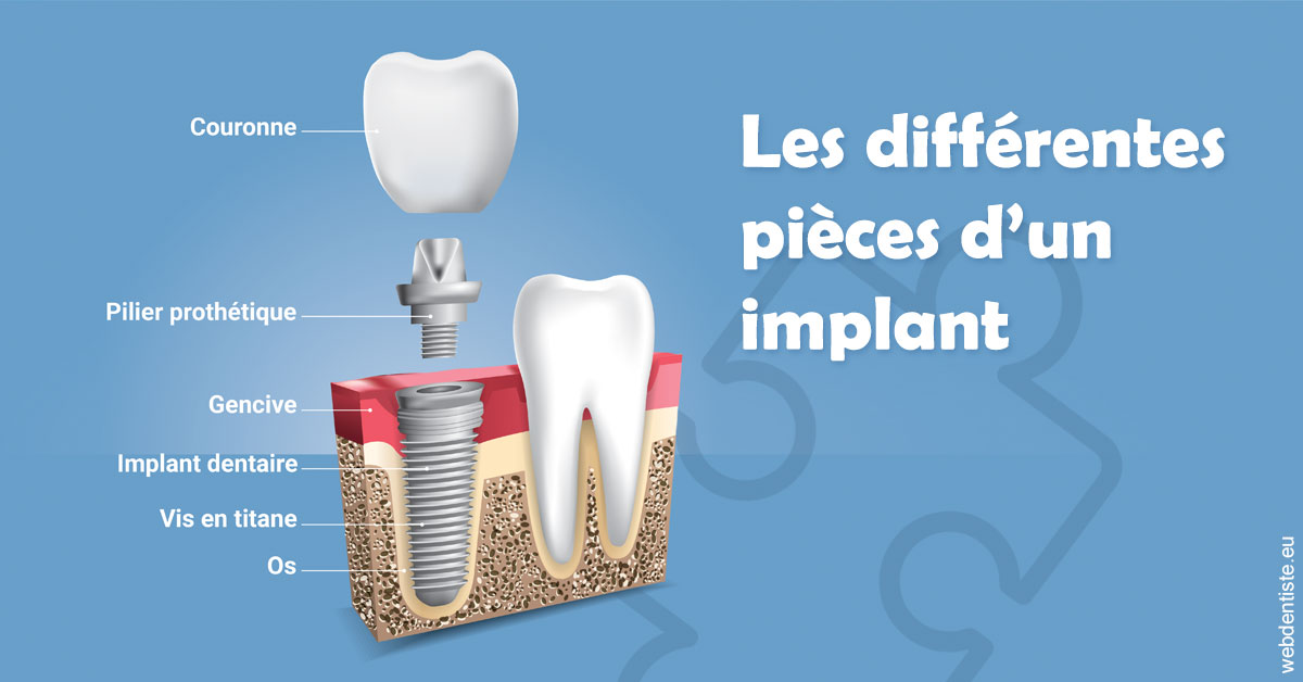 https://selarl-cabdentaire-idrissi.chirurgiens-dentistes.fr/Les différentes pièces d’un implant 1